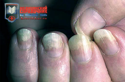 поражение ногтевых пластин при псориазе