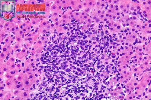 Как выглядит Аутоиммунный гепатит под микроскопом