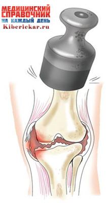 Изображение - Сколько стоит операция на мениск коленного сустава povrezhdenie-vnutrennego-meniska-kolennogo-sustava