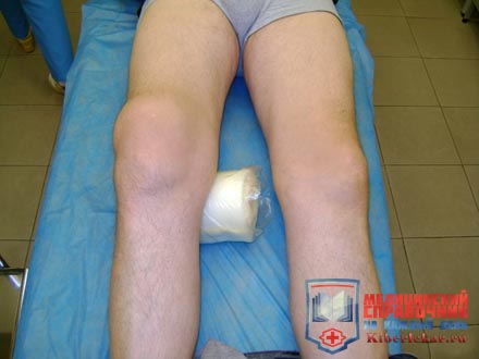 Синовит коленного сустава лечение