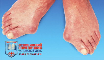 артрит пальцев ног