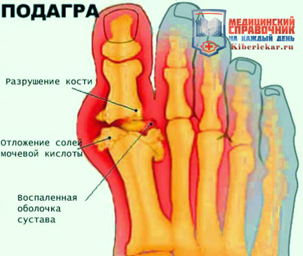 симптомы подагрического артрита