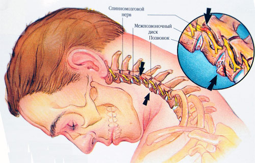 Боль при шейном остеохондрозе возникает из за защемления спинномозгового мозга в области шеи
