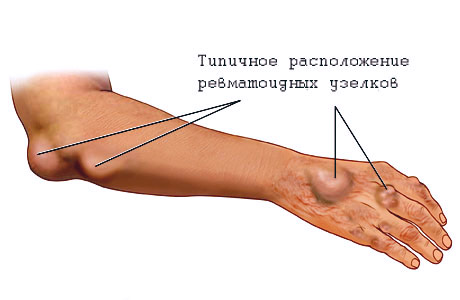 Ревматоидные узелки на руке появляются при отсутствии лечения заболевания