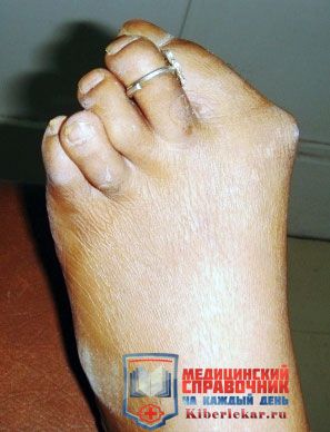 полиартрит пальцев ног