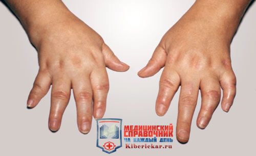 псориатический артрит суставов пальцев рук фото