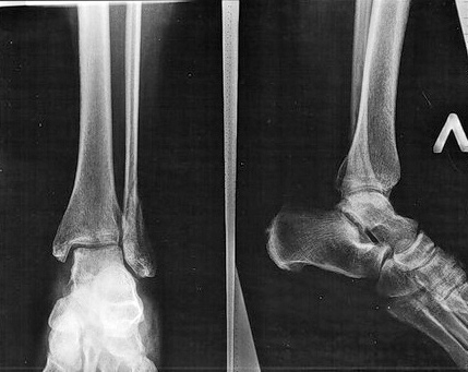 рентген перелома лодыжки фото